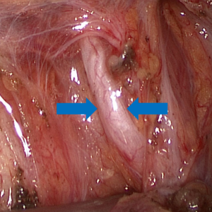 This is a picture of the recurrent laryngeal nerve as it appears to the surgeon during a thyroid or parathyroid operation. The nerve is between the two blue arrows. It has a characteristic white color, with small red blood vessels on the surface.