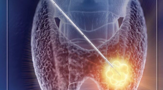 Is radiofrequency ablation an option for my thyroid nodule?